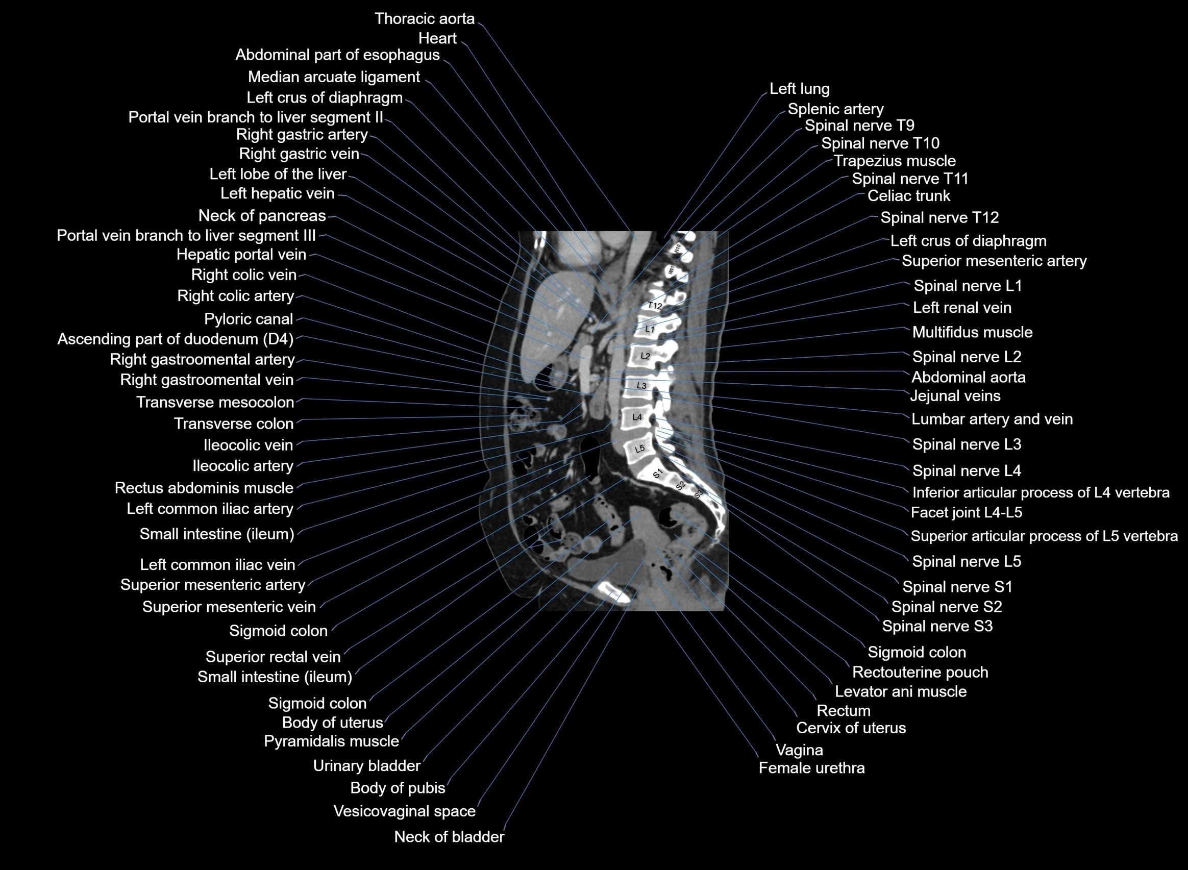 CT Abdomen sagittal cross sectional anatomy labelled radiology image -00057.webp